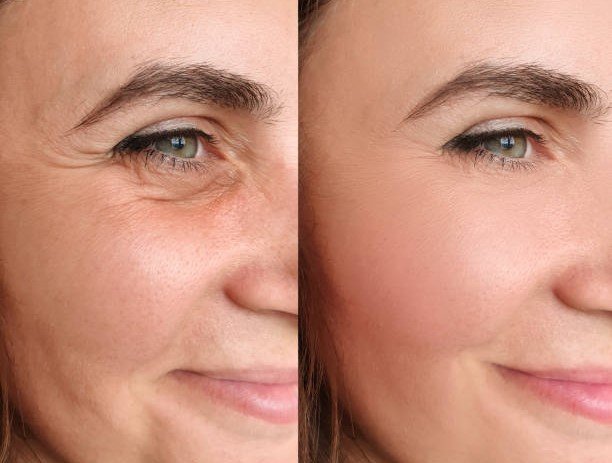 Botox Treatment in Gurgaon | Konarc Aesthetics